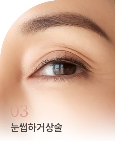 중년 눈성형 상세01 리스트3