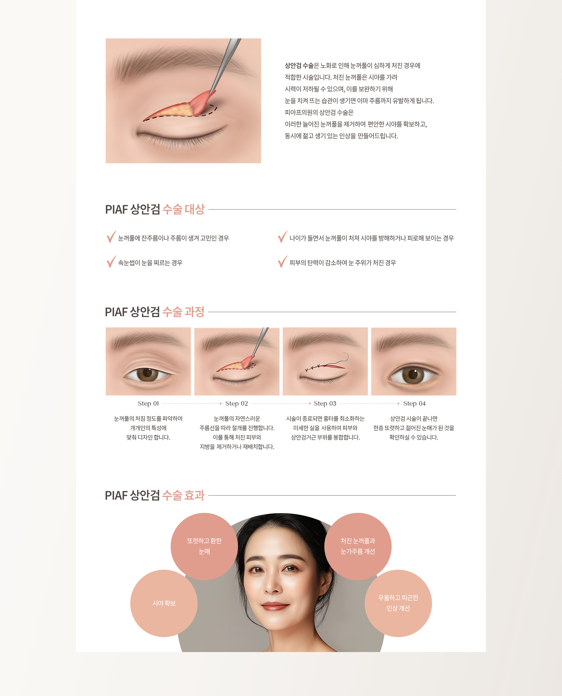 중년 눈성형 상세03