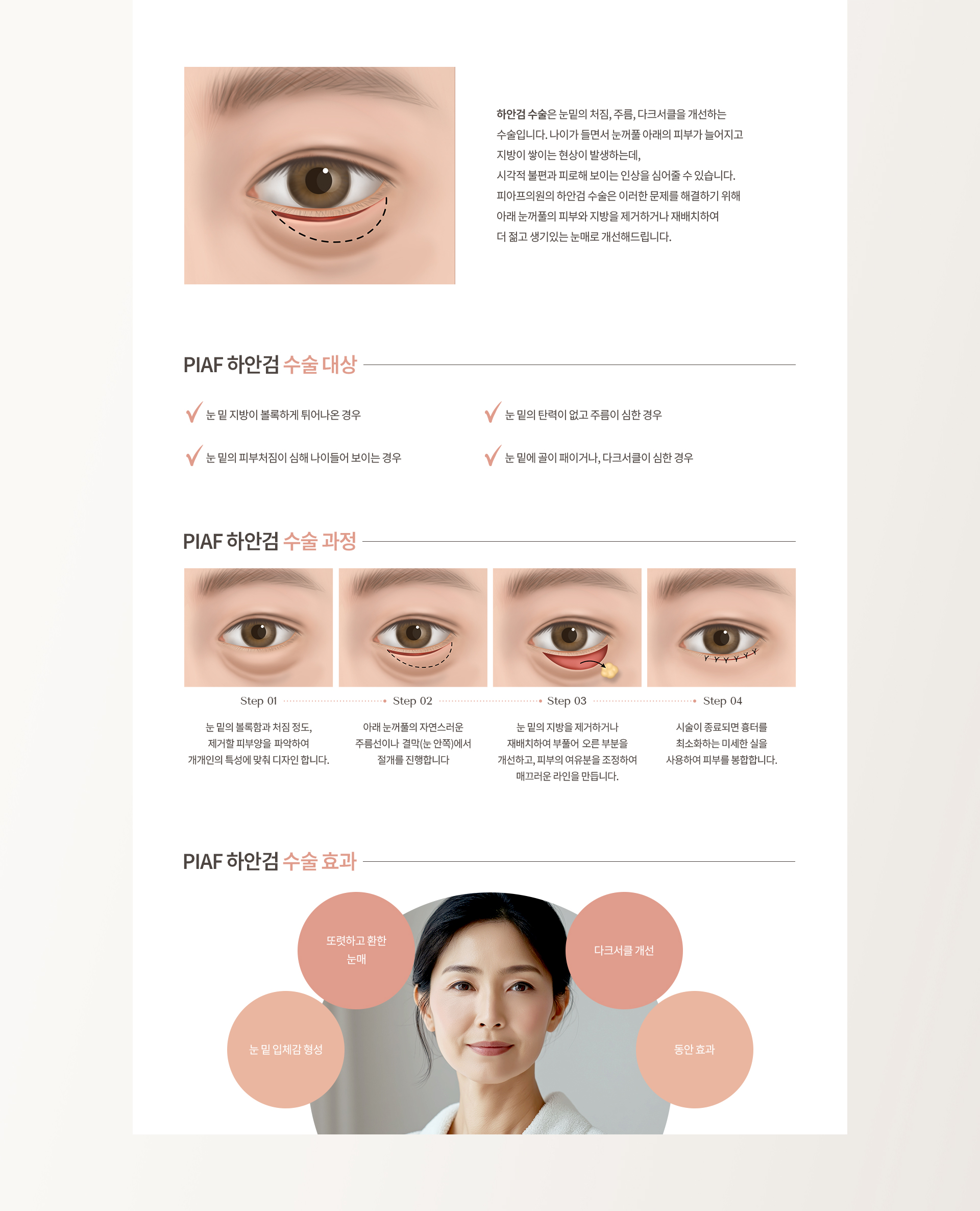 중년 눈성형 상세05
