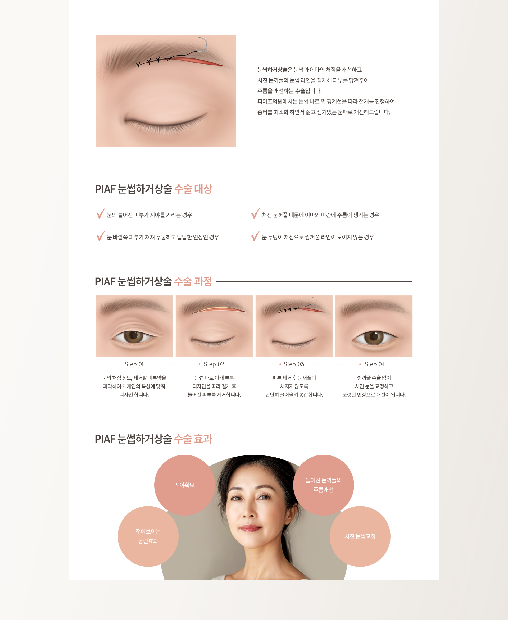 중년 눈성형 상세07