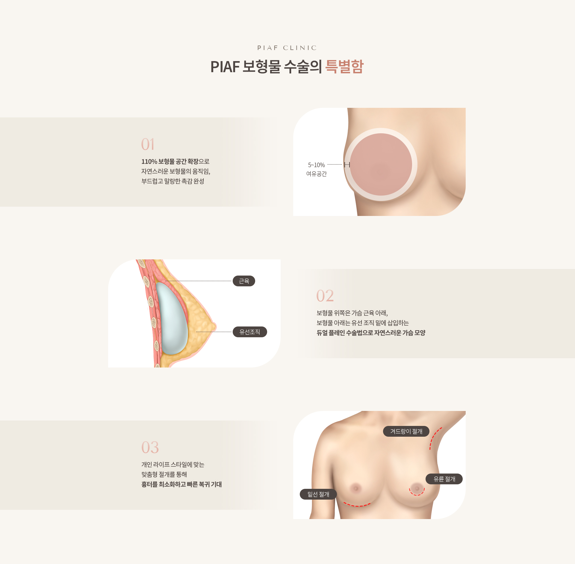 보형물 수술 상세04
