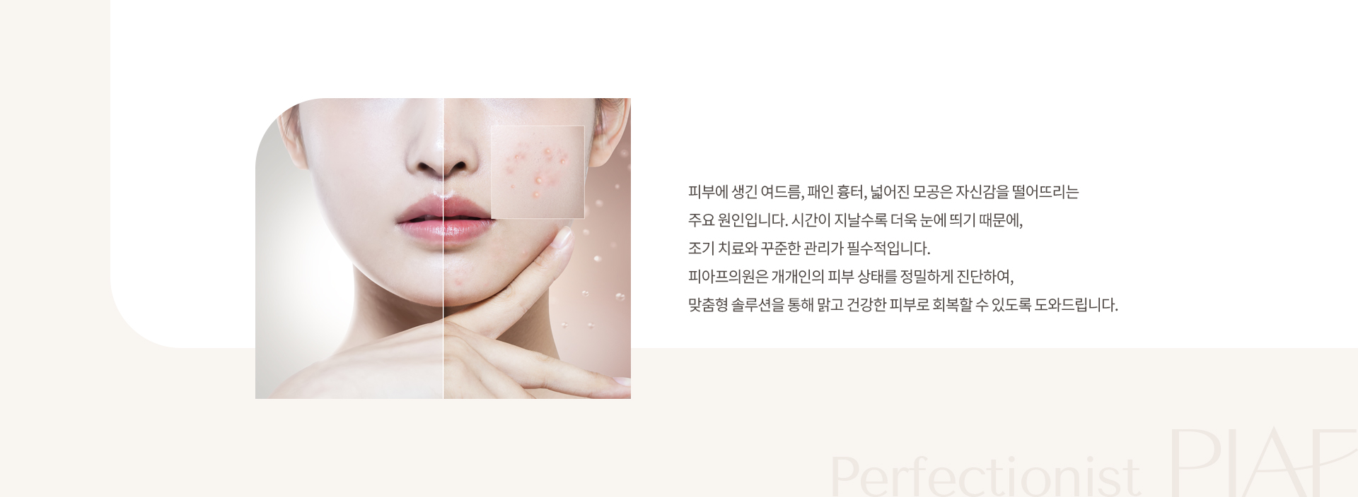 여드름/모공/흉터 상세01